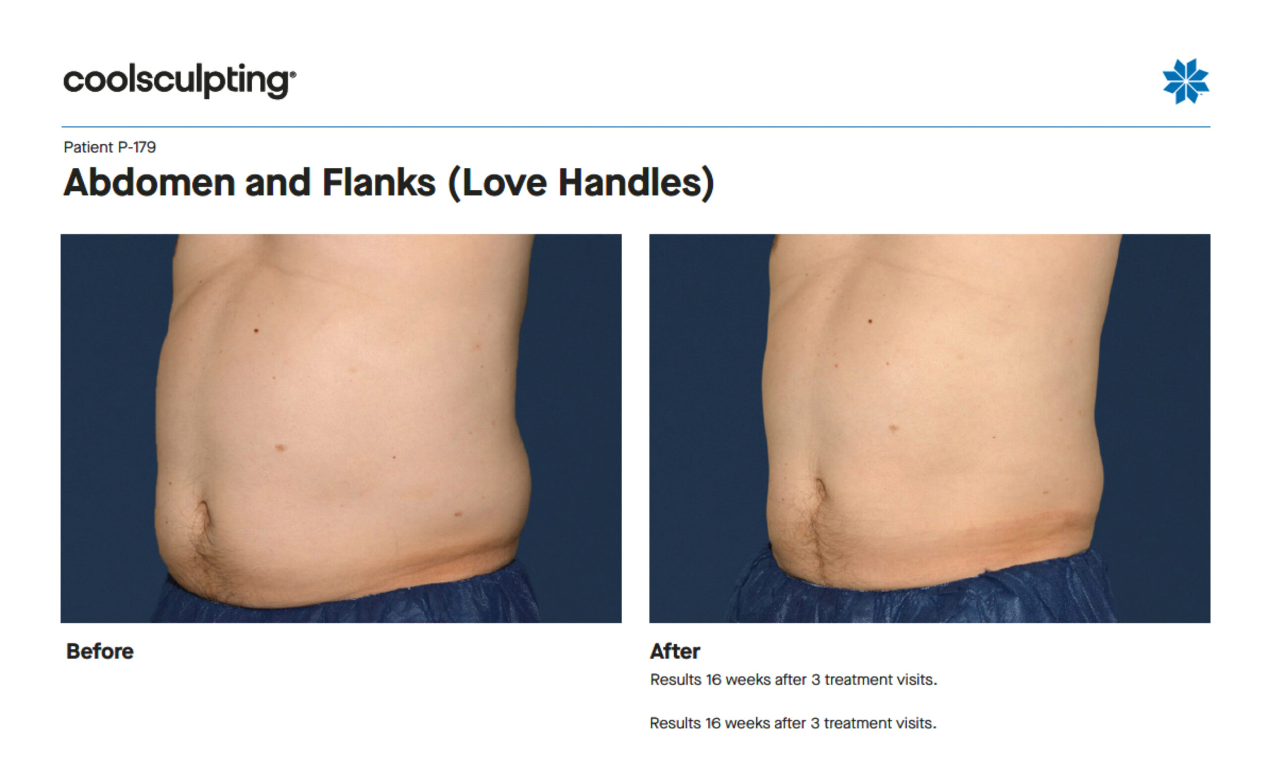 Abdomen:Flanks resized