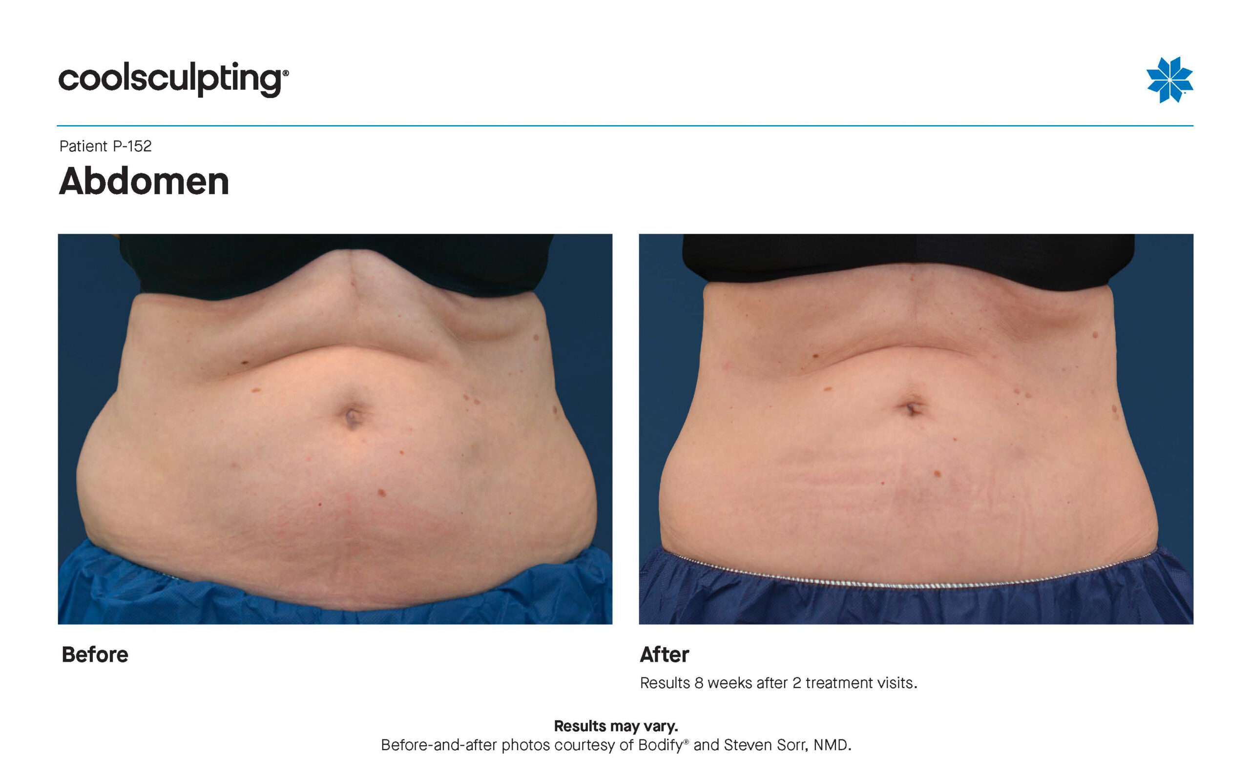 P-152 Abdomen_Bodify (2)-2